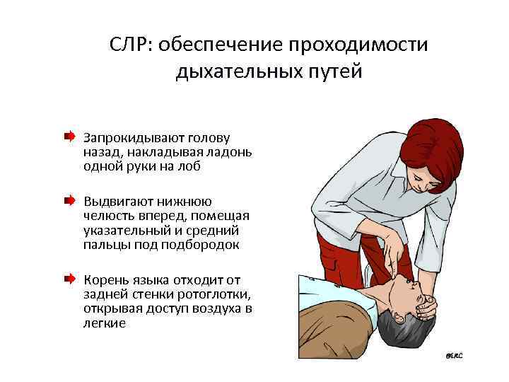 СЛР: обеспечение проходимости дыхательных путей Запрокидывают голову назад, накладывая ладонь одной руки на лоб