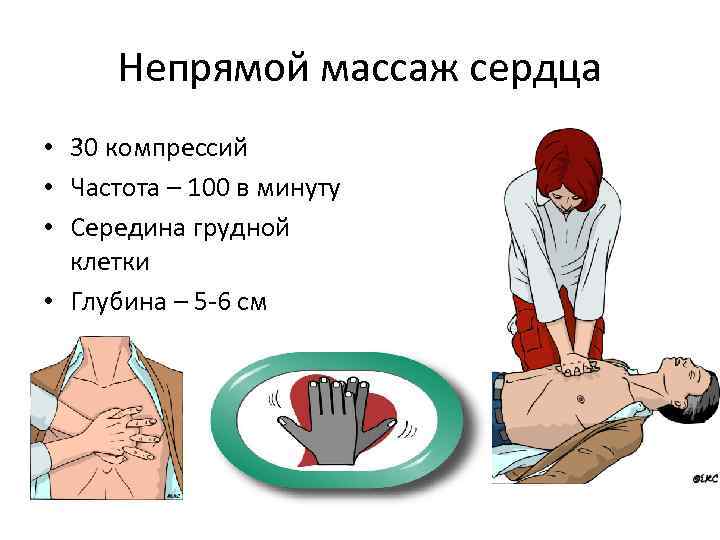 Непрямой массаж сердца • 30 компрессий • Частота – 100 в минуту • Середина