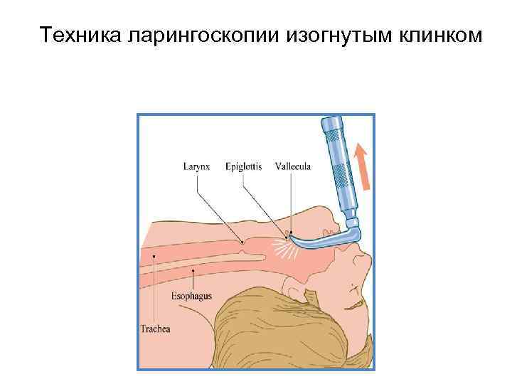 Техника ларингоскопии изогнутым клинком 