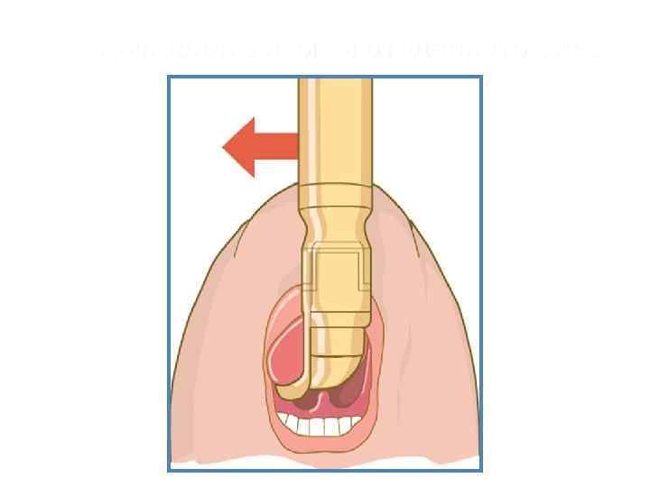 Приподнять язык и отодвинуть влево 
