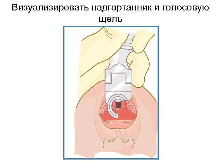 Визуализировать надгортанник и голосовую щель 