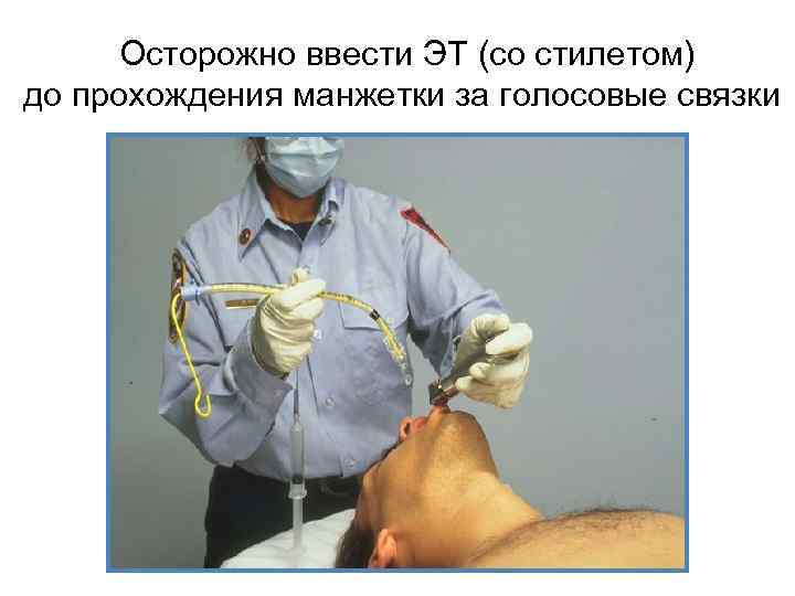 Осторожно ввести ЭТ (со стилетом) до прохождения манжетки за голосовые связки. 