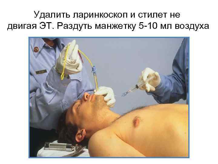 Удалить ларинкоскоп и стилет не двигая ЭТ. Раздуть манжетку 5 -10 мл воздуха 