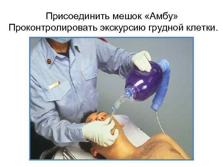 Присоединить мешок «Амбу» Проконтролировать экскурсию грудной клетки. 