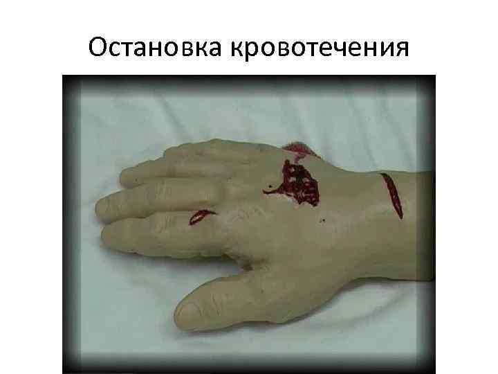 Остановка кровотечения 