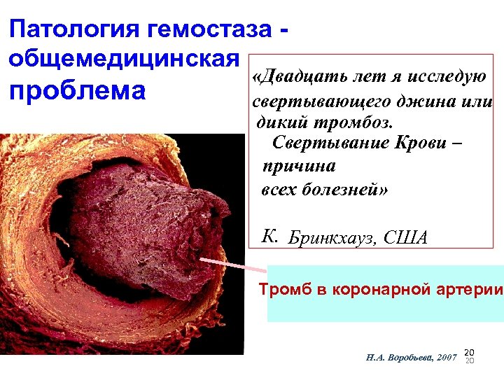 Патология гемостаза общемедицинская проблема «Двадцать лет я исследую свертывающего джина или дикий тромбоз. Свертывание