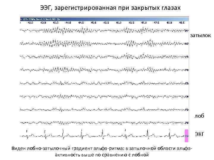 Ээг детям нижний новгород. Альфа ритм ЭЭГ при эпилепсии. Синхронизация Альфа ритма на ЭЭГ. Альфа ритмы головного мозга. ЭЭГ при закрытых глазах.