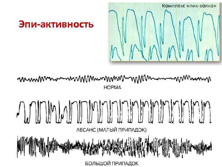 Комплекс «пик-волна» Эпи-активность 