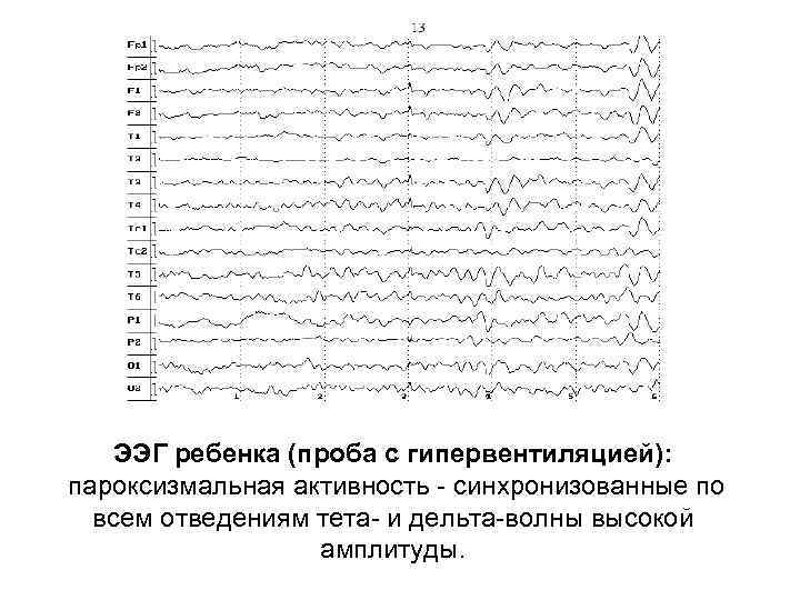 ЭЭГ ребенка (проба с гипервентиляцией): пароксизмальная активность - синхронизованные по всем отведениям тета- и
