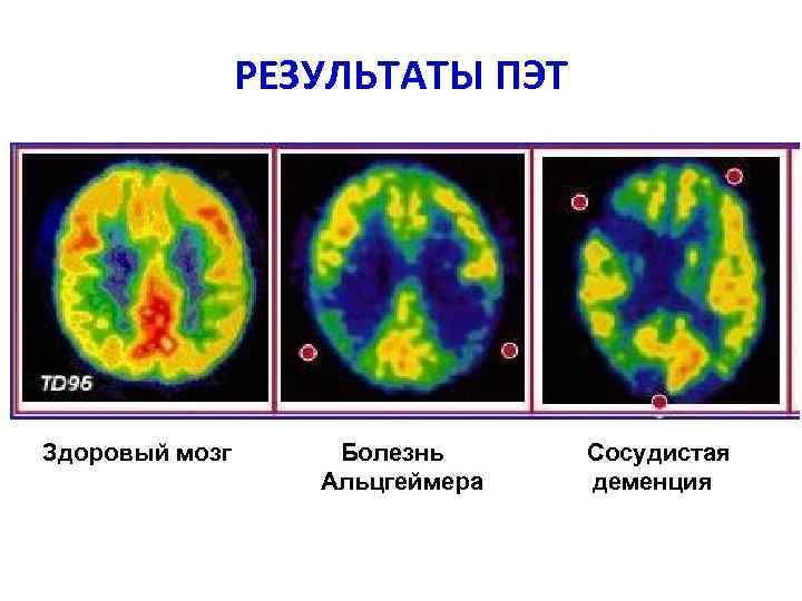 РЕЗУЛЬТАТЫ ПЭТ Здоровый мозг Болезнь Альцгеймера Сосудистая деменция 