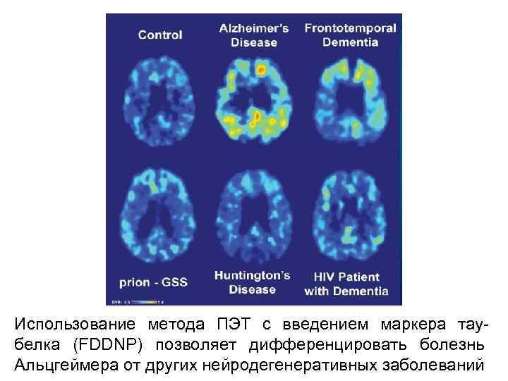 Использование метода ПЭТ с введением маркера таубелка (FDDNP) позволяет дифференцировать болезнь Альцгеймера от других