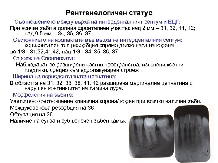 Рентгенелогичен статус Съотношението между върха на интерденталният септум и ЕЦГ: При всички зъби в