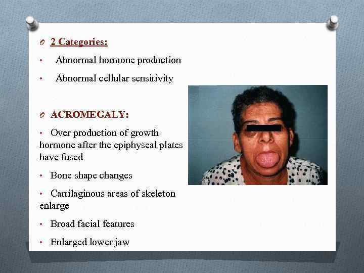 O 2 Categories: • Abnormal hormone production • Abnormal cellular sensitivity O ACROMEGALY: •