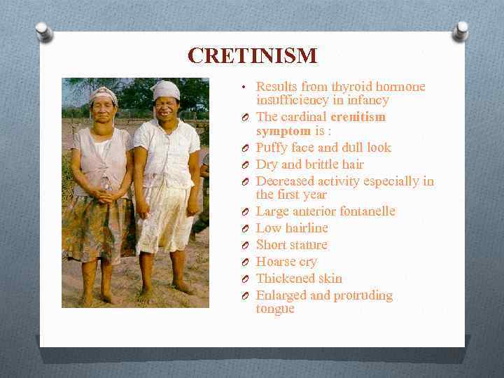 CRETINISM • Results from thyroid hormone O O O O O insufficiency in infancy