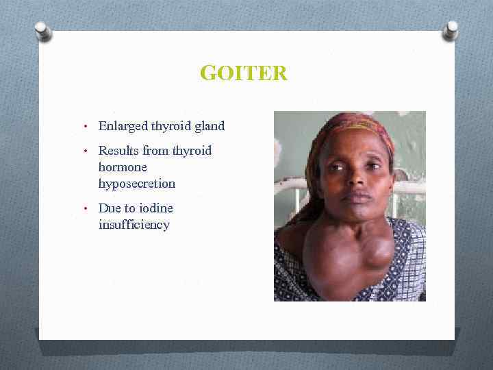 GOITER • Enlarged thyroid gland • Results from thyroid hormone hyposecretion • Due to