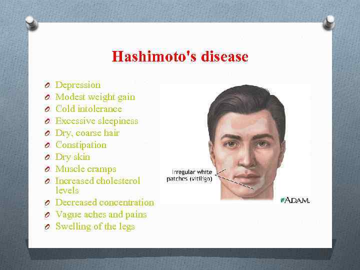 Hashimoto's disease Depression Modest weight gain Cold intolerance Excessive sleepiness Dry, coarse hair Constipation