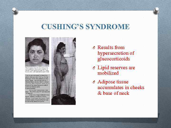 CUSHING’S SYNDROME O Results from hypersecretion of glucocorticoids O Lipid reserves are mobilized O
