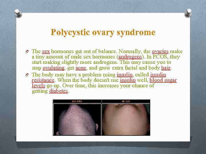 Polycystic ovary syndrome O The sex hormones get out of balance. Normally, the ovaries