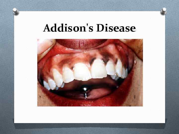 Addison's Disease 