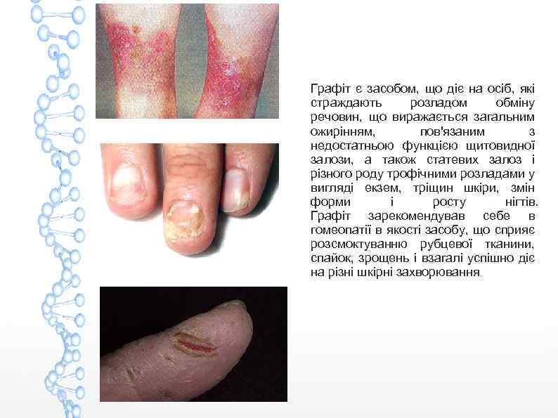 Графіт є засобом, що діє на осіб, які страждають розладом обміну речовин, що виражається