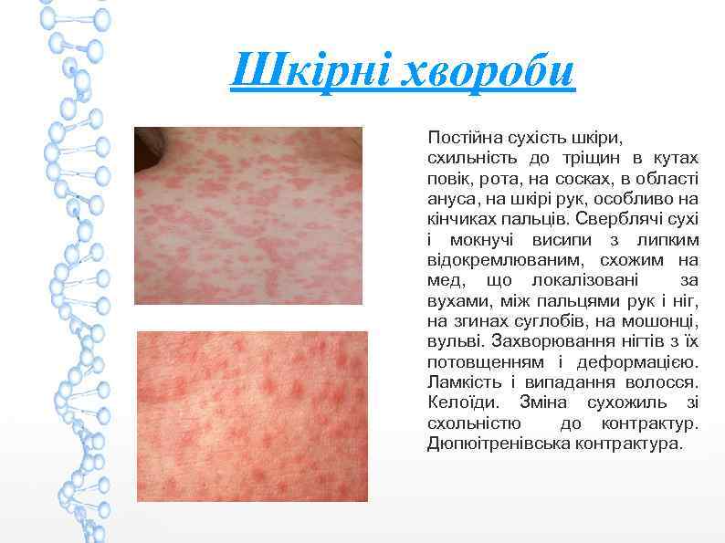 Шкірні хвороби Постійна сухість шкіри, схильність до тріщин в кутах повік, рота, на сосках,