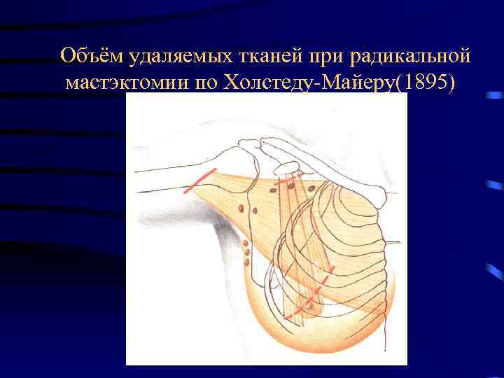  Объём удаляемых тканей при радикальной мастэктомии по Холстеду-Майеру(1895) 