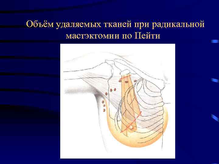  Объём удаляемых тканей при радикальной мастэктомии по Пейти 