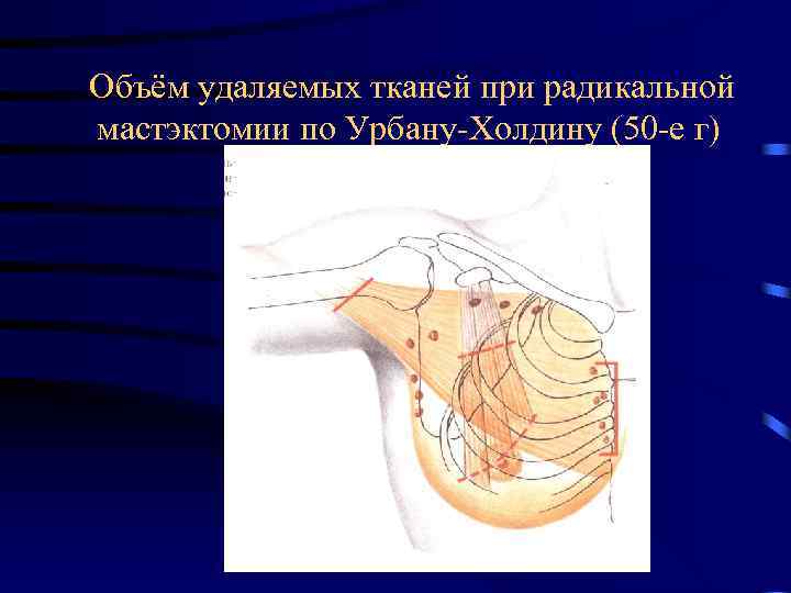  Объём удаляемых тканей при радикальной мастэктомии по Урбану-Холдину (50 -е г) 