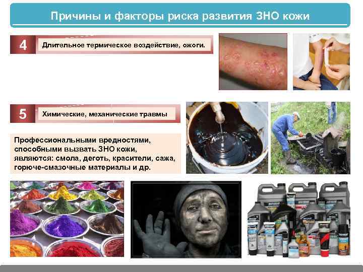 Причины и факторы риска развития ЗНО кожи 4 Длительное термическое воздействие, ожоги. 5 Химические,