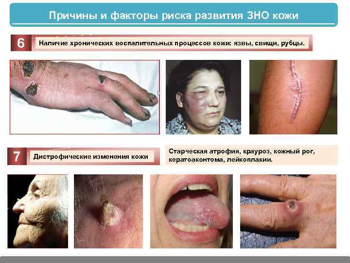 Причины и факторы риска развития ЗНО кожи 6 7 Наличие хронических воспалительных процессов кожи: