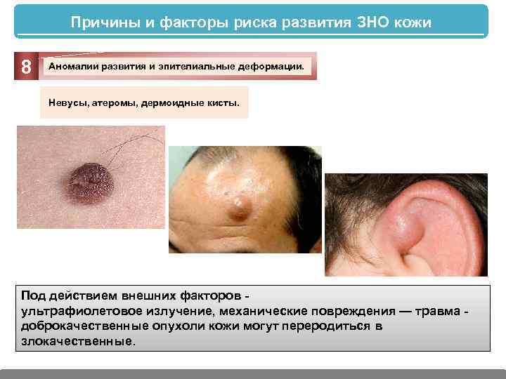 Причины и факторы риска развития ЗНО кожи 8 Аномалии развития и эпителиальные деформации. Невусы,