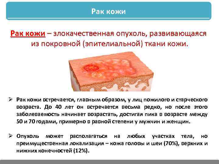 Рак кожи – злокачественная опухоль, развивающаяся из покровной (эпителиальной) ткани кожи. Ø Рак кожи