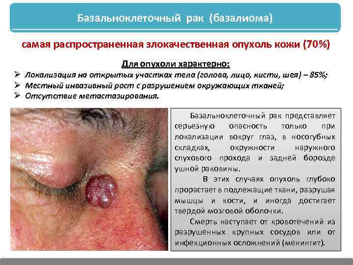 Базальноклеточный рак (базалиома) самая распространенная злокачественная опухоль кожи (70%) Для опухоли характерно: Ø Локализация