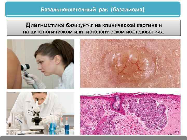Базальноклеточный рак (базалиома) Диагностика базируется на клинической картине и на цитологическом или гистологическом исследованиях.