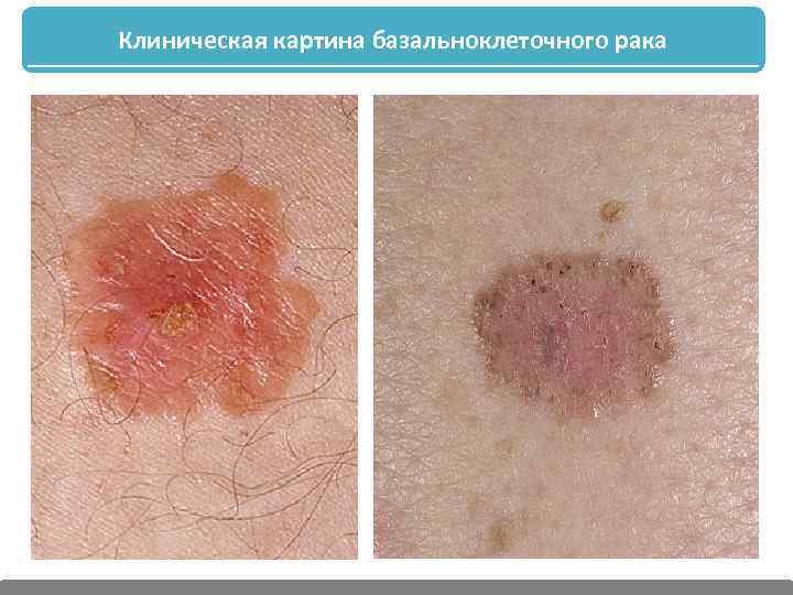 Клиническая картина базальноклеточного рака 
