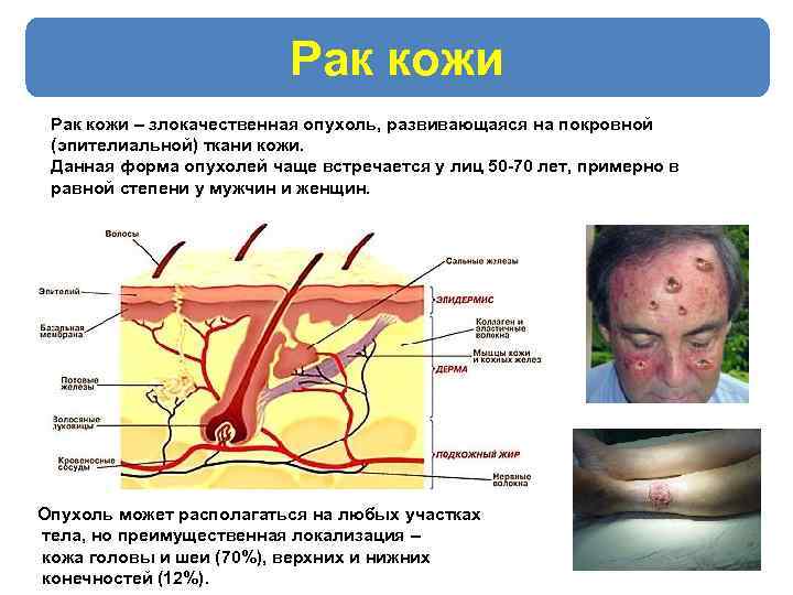 Рак кожи – злокачественная опухоль, развивающаяся на покровной (эпителиальной) ткани кожи. Данная форма опухолей