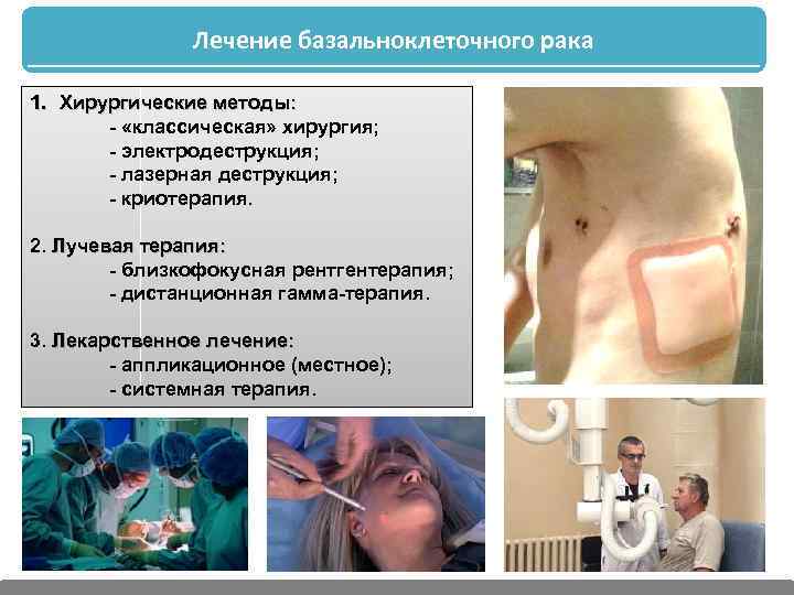 Лечение базальноклеточного рака 1. Хирургические методы: - «классическая» хирургия; - электродеструкция; - лазерная деструкция;