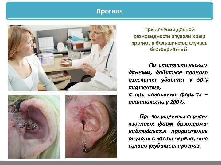 Прогноз При лечении данной разновидности опухоли кожи прогноз в большинстве случаев благоприятный. По статистическим