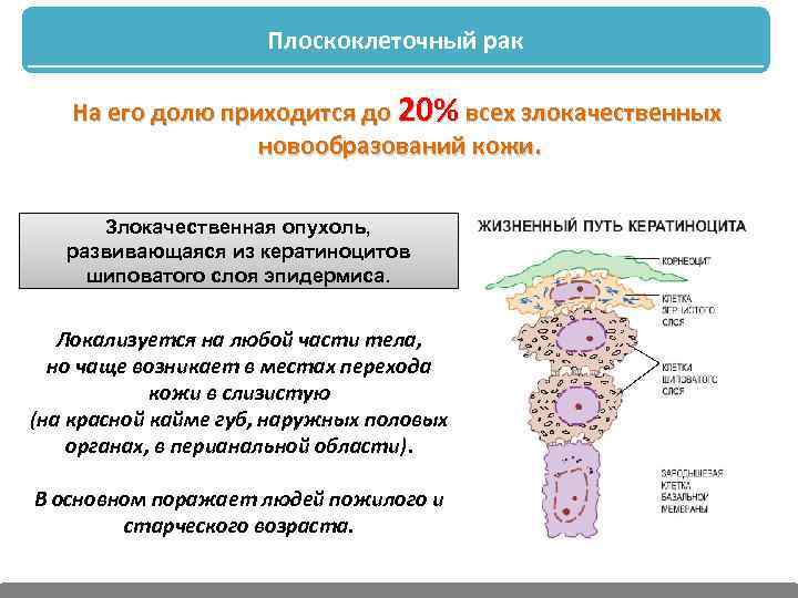 Плоскоклеточный рак На его долю приходится до 20% всех злокачественных новообразований кожи. Злокачественная опухоль,