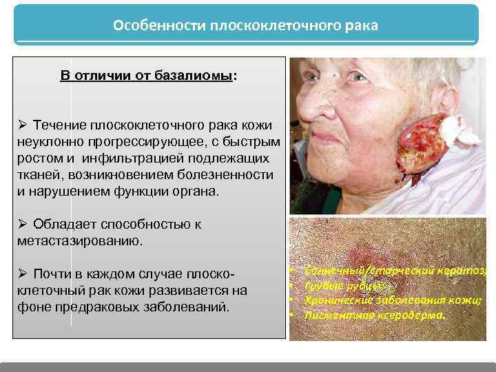 Особенности плоскоклеточного рака В отличии от базалиомы: Ø Течение плоскоклеточного рака кожи неуклонно прогрессирующее,