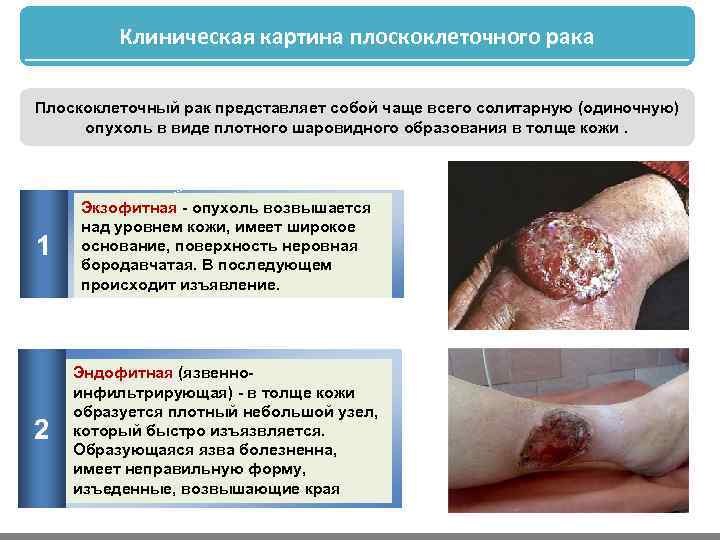 Клиническая картина плоскоклеточного рака Плоскоклеточный рак представляет собой чаще всего солитарную (одиночную) опухоль в