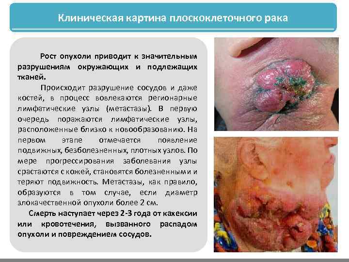 Клиническая картина плоскоклеточного рака Рост опухоли приводит к значительным разрушениям окружающих и подлежащих тканей.