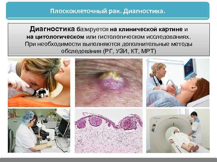 Плоскоклеточный рак. Диагностика базируется на клинической картине и на цитологическом или гистологическом исследованиях. При