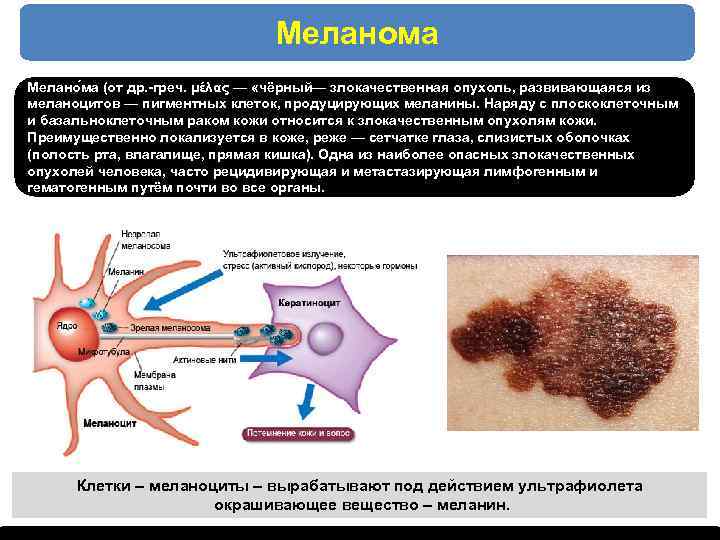 Меланома Мелано ма (от др. -греч. μέλας — «чёрный— злокачественная опухоль, развивающаяся из меланоцитов