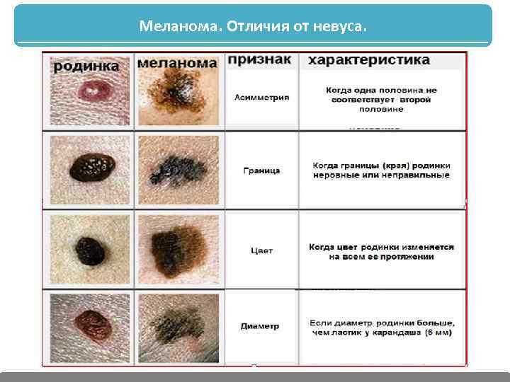 Меланома. Отличия от невуса. 