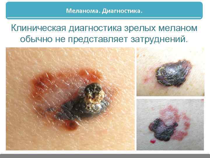Меланома. Диагностика. Клиническая диагностика зрелых меланом обычно не представляет затруднений. 