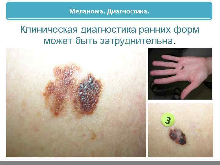 Меланома. Диагностика. Клиническая диагностика ранних форм может быть затруднительна. 