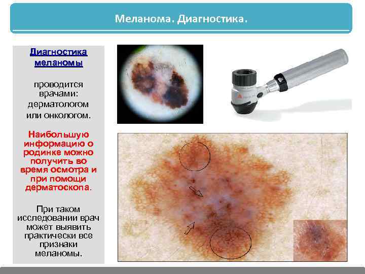 Меланома. Диагностика меланомы проводится врачами: дерматологом или онкологом. Наибольшую информацию о родинке можно получить