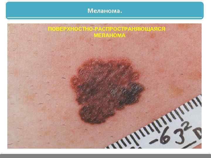 Меланома. ПОВЕРХНОСТНО-РАСПРОСТРАНЯЮЩАЯСЯ МЕЛАНОМА 