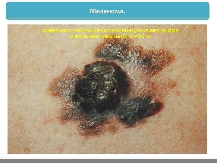 Меланома. ПОВЕРХНОСТНО-РАСПРОСТРАНЯЮЩАЯСЯ МЕЛАНОМА В ФАЗЕ ВЕРТИКАЛЬНОГО РОСТА 
